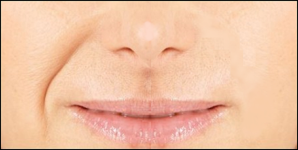 片方だけほうれい線が出る