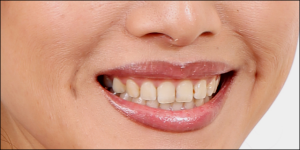 ほうれい線が目立って老けた芸能人