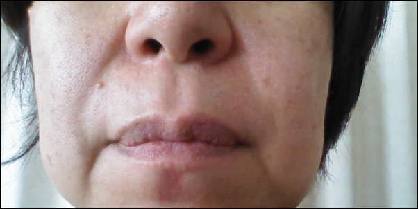 ほうれい線を気にする人は?