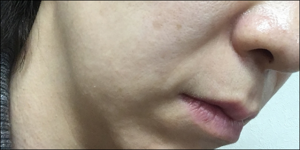 ほうれい線が気になる年齢