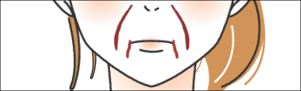ほうれい線とマリオネットラインがある