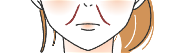 ほうれい線が外向き