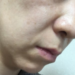 ほうれい線ができる年齢