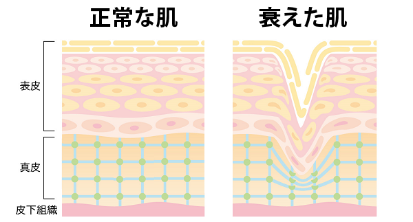 ほうれい線やしわの原因