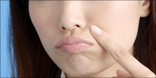 ほうれい線にはコラーゲン